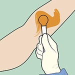 Line drawing of skin prep being applied to the block site or side.