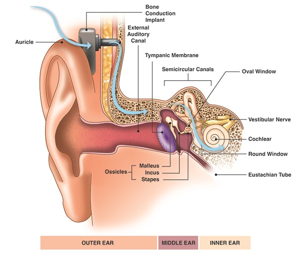A anatomical drawing of the ear showing the features of the inner, middle and outer ear and placement of a bone conduction implant.