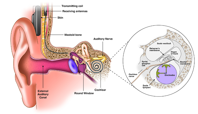 A anatomical drawing of the ear showing the features of the ear and placement of a cochlear implant, receiving antennas and electrode