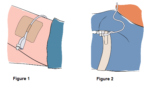 Figure 3 and 4 Diagram showing a catheter attached a person&rsquo;s upper thigh using an adhesive