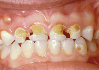A young child&rsquo;s mouth showing yellowed and crumbling teeth &ndash; a sign of advanced early childhood dental decay. 