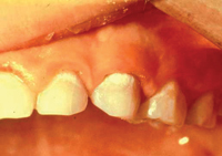 An infant&rsquo;s teeth showing white spots on the gum line, which is an early sign of decay
